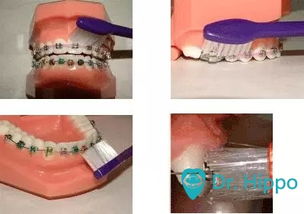 牙套君如何正確清潔牙齒與通用鞋類護(hù)理指南